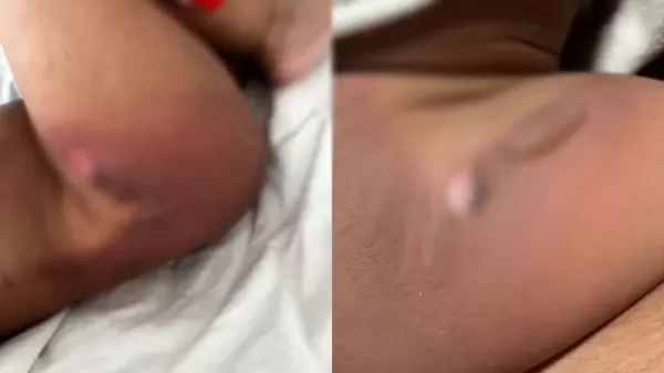 Bebê de 11 meses sofre queimaduras durante banho em creche municipal de Jaú