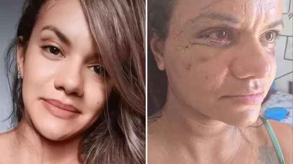 Juliana dos Santos, agredida com 61 socos em elevador, mostra recuperação uma semana após cirurgia