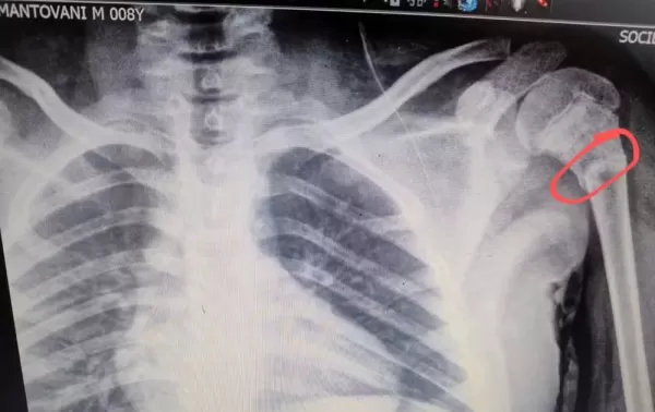 Família denuncia possível negligência após menino cadeirante sofrer fratura dentro da Apae de Piraju