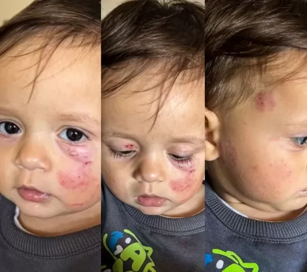 Mãe encontra bebê com hematomas em creche de Criciúma; Polícia Civil investiga caso