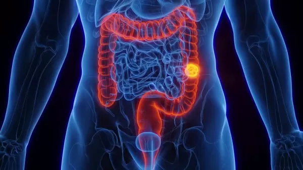 SUS adotará novo exame para rastreamento do câncer de intestino em brasileiros entre 50 e 75 anos