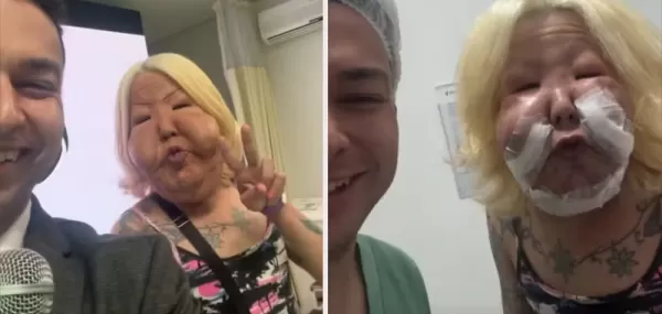 Influenciadora “Juju do Pix” passa por primeira cirurgia para retirar óleo mineral aplicado ilegalmente no rosto