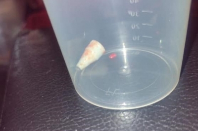 Menino tem ponta de lapiseira presa no pulmão por sete dias em Salto Grande 