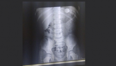 Menino de 4 anos engole moeda e pode precisar de cirurgia para retirá-la em Ourinhos