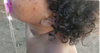 Justiça condena prefeitura da região a indenizar em R$ 5 mil família de criança arranhada em creche