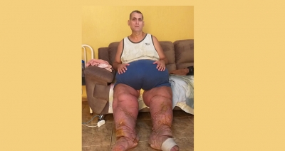 Portador da Filariose pede ajuda em Ourinhos para realizar tratamento 