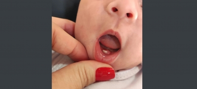 Bebê nasce com dente raro em maternidade na região 